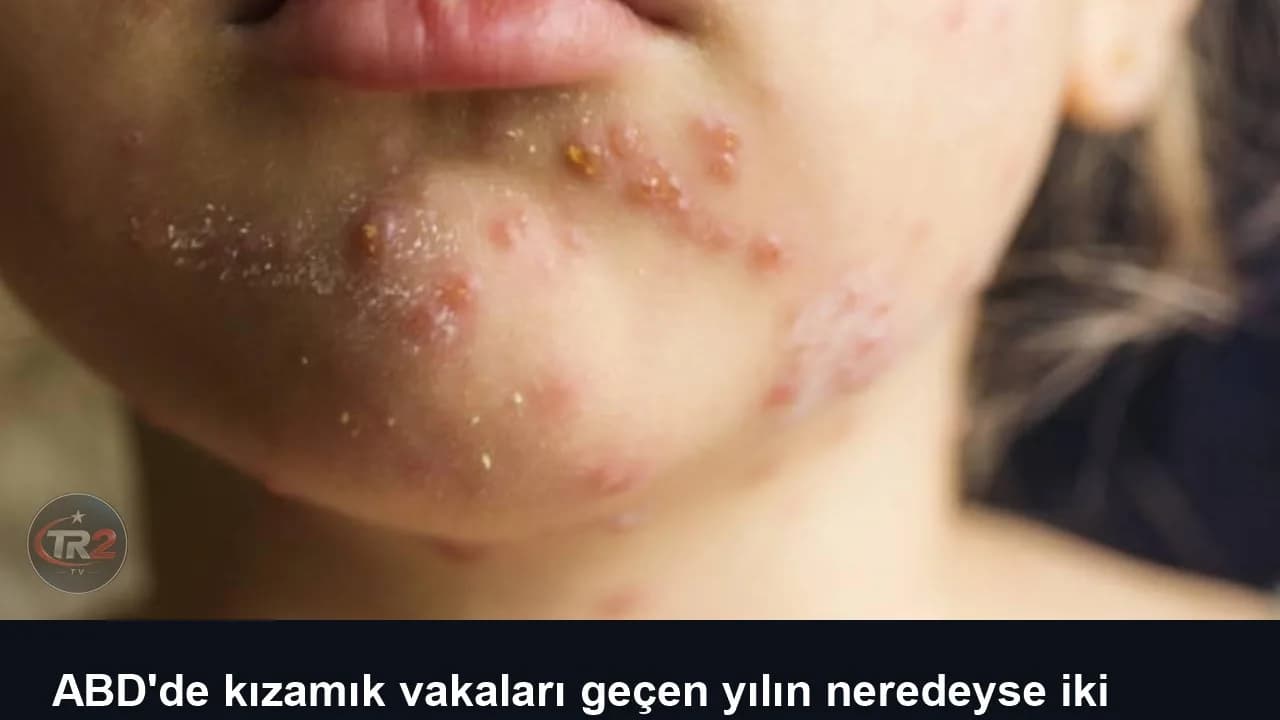 ABD'de kızamık vakaları geçen yılın neredeyse iki katına çıktı