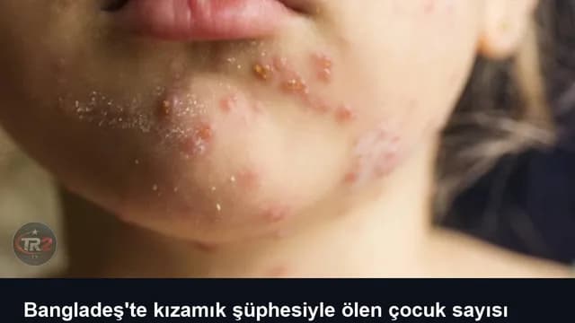 Bangladeş'te kızamık şüphesiyle ölen çocuk sayısı 1201'e yükseldi